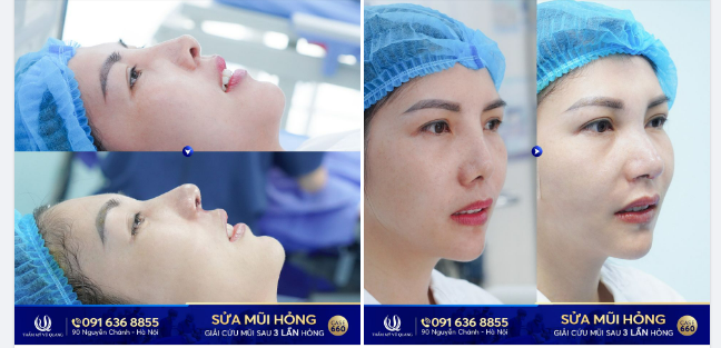 3 lần nâng mũi hỏng vì thiếu hiểu biết Khiến cuộc sống rơi vào bế tắc cùng cực.