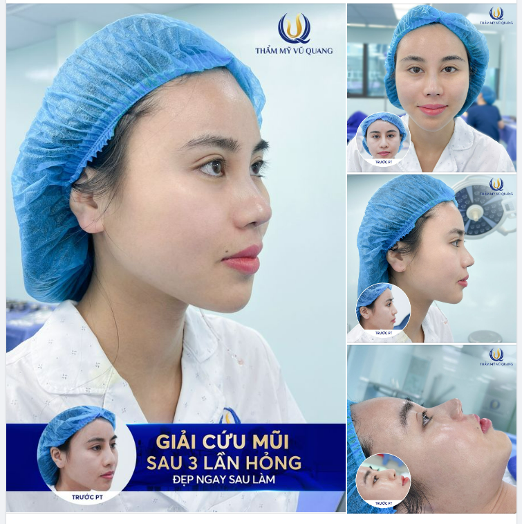 3 lần nâng mũi thất bại và sự thay đổi bất ngờ sau lần thứ 4