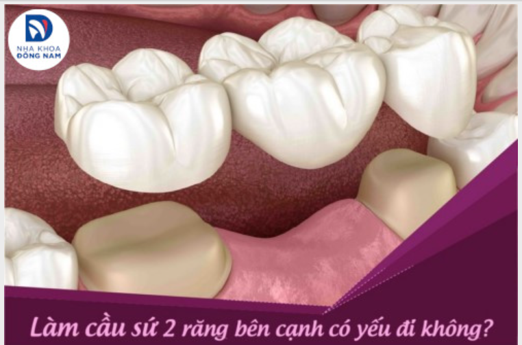 3 NHƯỢC ĐIỂM CỦA CẦU RĂNG SỨ KHIẾN BẠN LO LẮNG