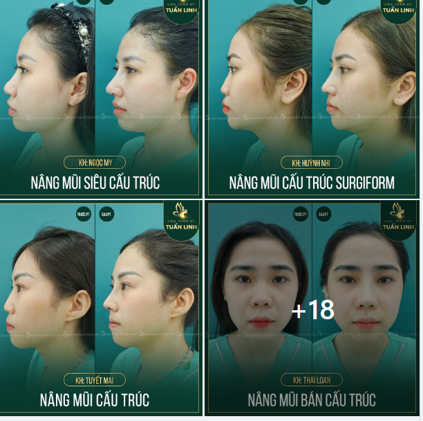 30 ca nâng mũi trong 2 ngày tại Tuấn Linh