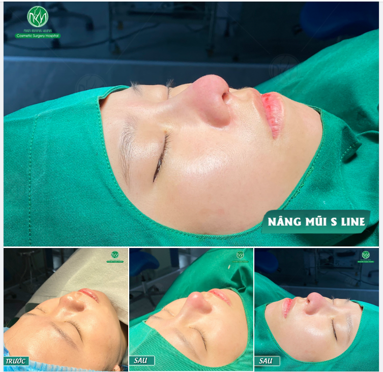 35TRIỆU SỞ HỮU NGAY DÁNG MŨI S LINE ĐẸP TOÀN DIỆN