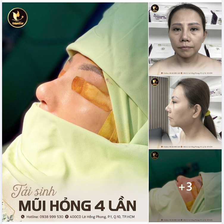 4 LẦN NÂNG MŨI – HẬU QUẢ ĐÈ NẶNG DR HOẠT – TÁI SINH MŨI HỎNG