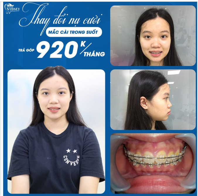 4 NGUYÊN TẮC CẦN TUÂN THỦ KHI ĐEO HÀM DUY TRÌ SAU NIỀNG RĂNG 