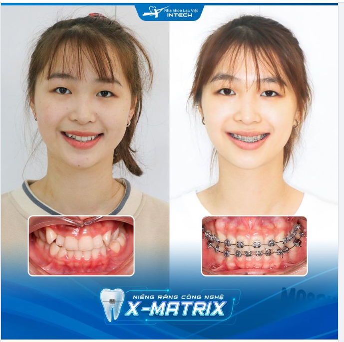 6 THÁNG NIỀNG RĂNG KHẤP KHỂNH THAY ĐỔI NHƯ THẾ NÀO?