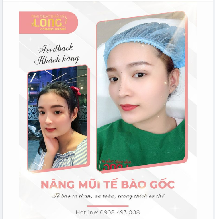 7 ngày vàng - thời gian quan trọng quyết định kết quả dáng mũi sau nâng