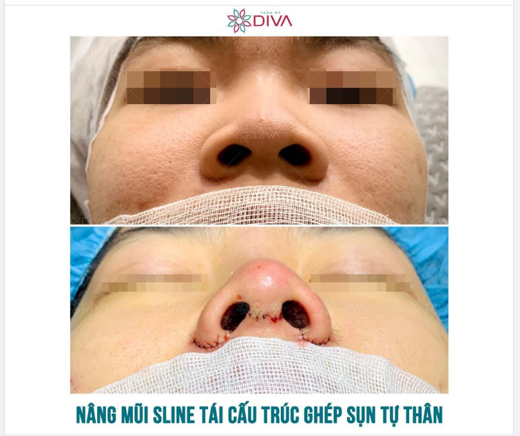 AI CŨNG CÓ THỂ NÂNG MŨI GHÉP SỤN TỰ THÂN ĐÚNG KHÔNG