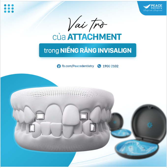ATTACHMENT (NÚT ĐẶT LỰC) LÀ GÌ VÀ VAI TRÒ QUAN TRỌNG CỦA ATTACHMENT TRONG NIỀNG RĂNG INVISALIGN
