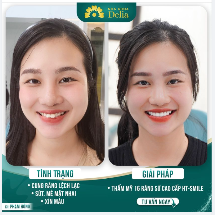 Bác sĩ rất tận tình, đặt sức khoẻ răng miệng của mình lên hàng đầu, tư vấn điều tốt nhất cho mình.