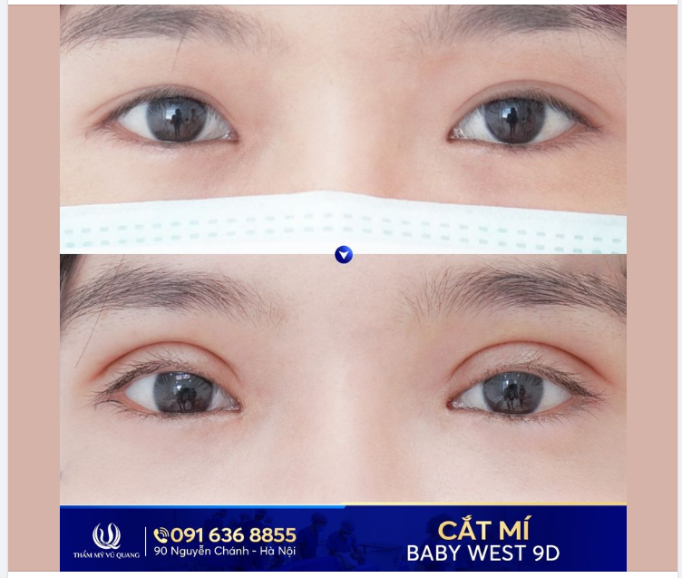 Bạn đang tìm hiểu về cắt mí thì nhất định không được bỏ qua bài viết dưới đây.