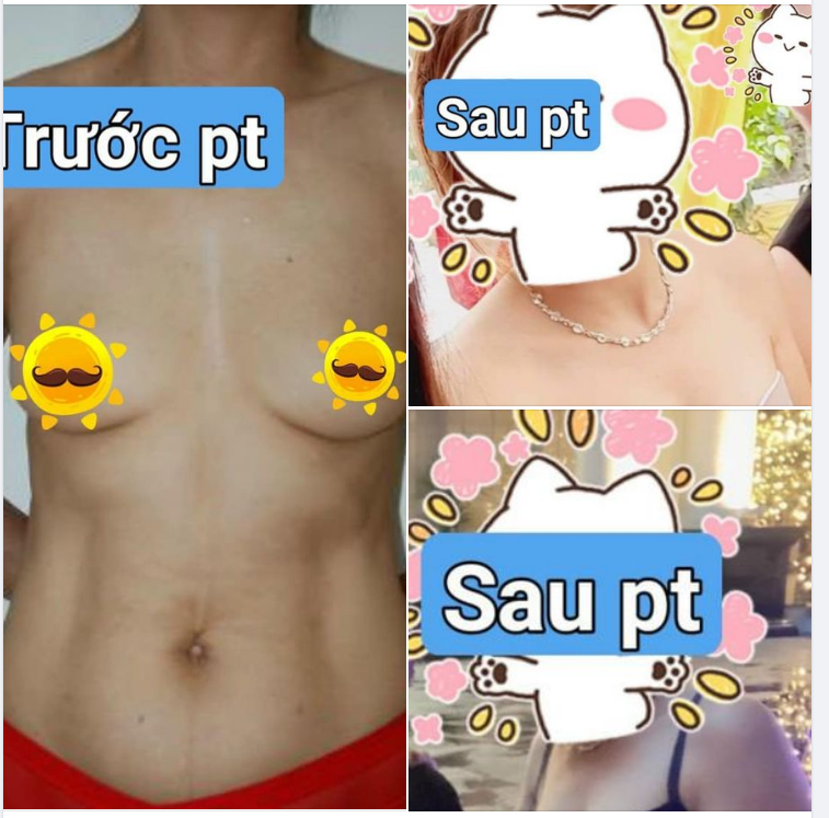 BẠN MẤT BAO LÂU MỚI CAN ĐẢM ĐỂ THỰC HIỆN PHẪU THUẬT NÂNG NGỰC