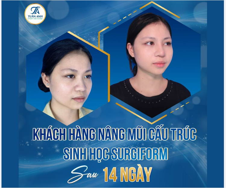 Bạn V. (23t, HN) đến gặp Bác sĩ Tuấn Anh với tình trạng mũi rất thấp, tẹt, đầu mũi dài, to bè mất cân đối.