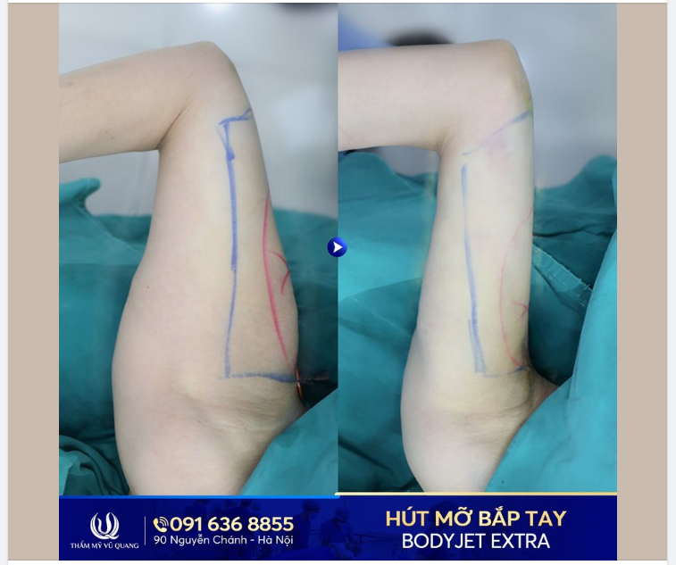 Bật mí bí quyết sỡ hữu ngay bắp tay thon gọn, mảnh mai.