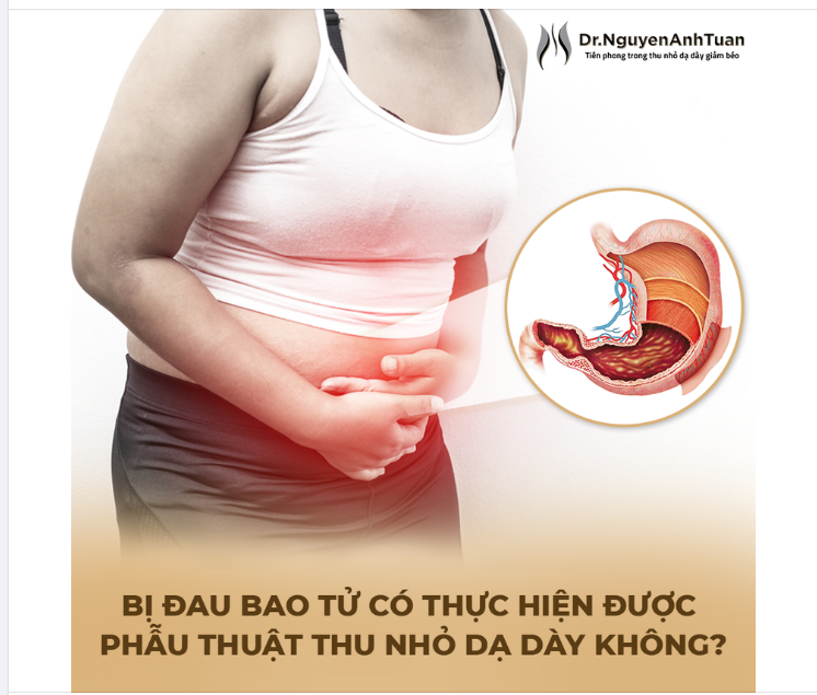 BỊ ĐAU BAO TỬ CÓ THỰC HIỆN ĐƯỢC PHẪU THUẬT THU NHỎ DẠ DÀY GIẢM BÉO KHÔNG