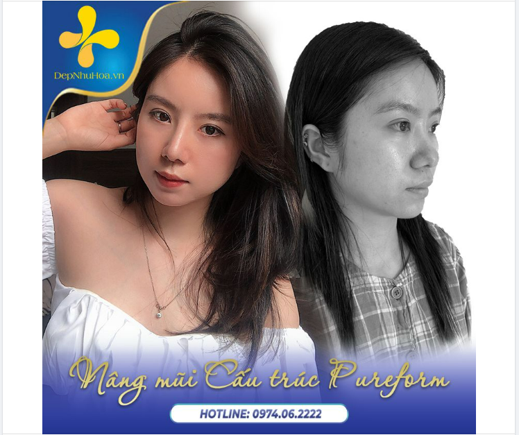 Bí quyết làm nên một khuôn mặt xinh tươi, rạng rỡ của chị em là DÁNG MŨI THANH CAO, THON GỌN TỰ NHIÊN