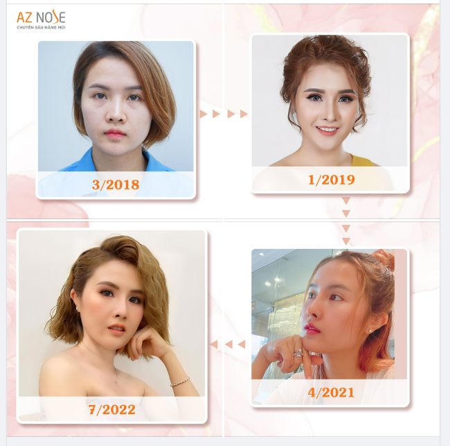 Biến hoá phong cách sau 4 năm tái tạo dáng mũi