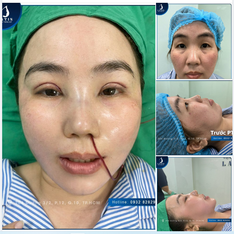 Biến hóa thành công, tân trang nhan sắc cho chị khách hàng nhà Latin