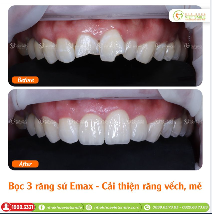 BỌC 3 RĂNG CỬA SỨ EMAX - CẢI THIỆN RĂNG VẾCH, MẺ