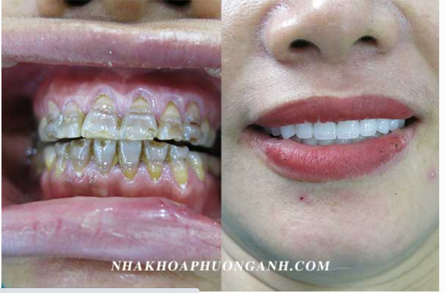 Bọc răng nếu đúng cách thì không bị tụt ra vì xi-măng gắn là loại gắn vĩnh viễn, muốn lấy ra chỉ có thể cắt bỏ răng sứ thành nhiều phần rồi lấy ra từ từ.