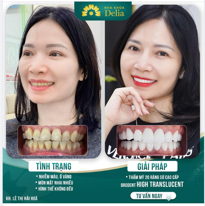 Bọc răng sứ thẩm mỹ tại Delia - hạn chế mài nhỏ, cười tự tin chỉ sau 2 lần hẹn