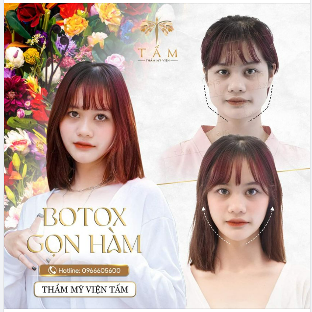 BOTOX GỌN HÀM ​​​​​​​ CHÌA KHOÁ LOẠI BỎ KHUÔN MẶT GÓC CẠNH
