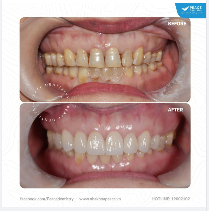 Ca lâm sàng  mặt dán sứ veneer với mong muốn "đẹp tự nhiên và nhìn như răng thật"