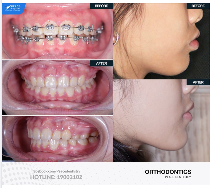 CA LÂM SÀNG NIỀNG RĂNG CHỈNH HÔ VỚI MẮC CÀI KIM LOẠI