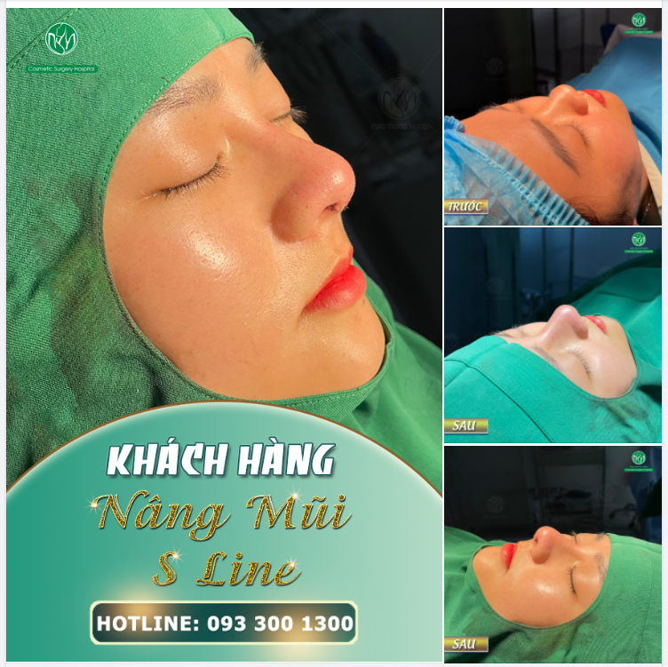 CA NÂNG MŨI S LINE SÁNG THỨ 2 ĐẦU TUẦN