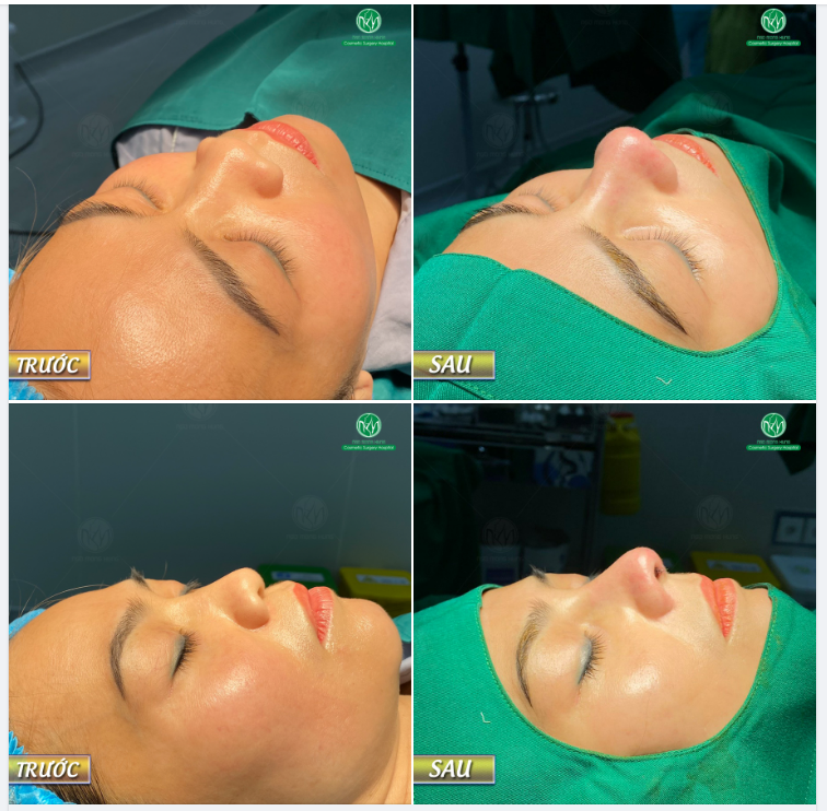 CA NÂNG MŨI S LINE SỬA LẠI CHO KH