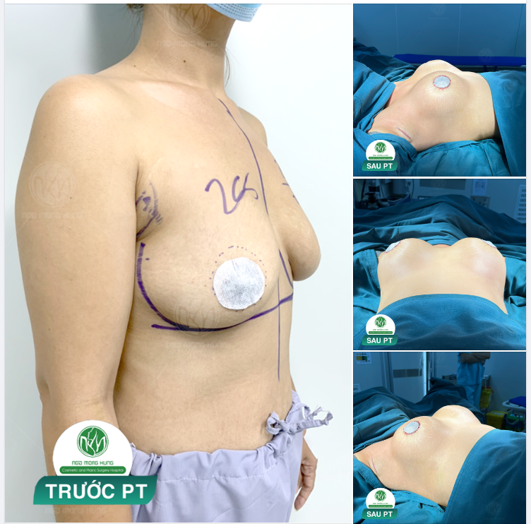 CA NÂNG NGỰC SÁNG NAY ĐÃ CÓ KẾT QUẢ