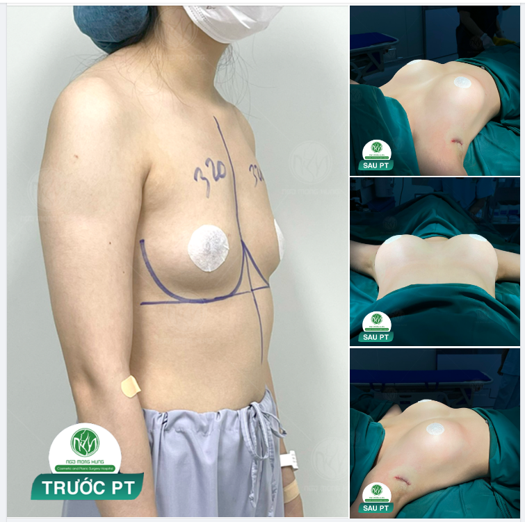 CA NGỰC ĐƯỜNG NÁCH CHO BUỔI CHIỀU