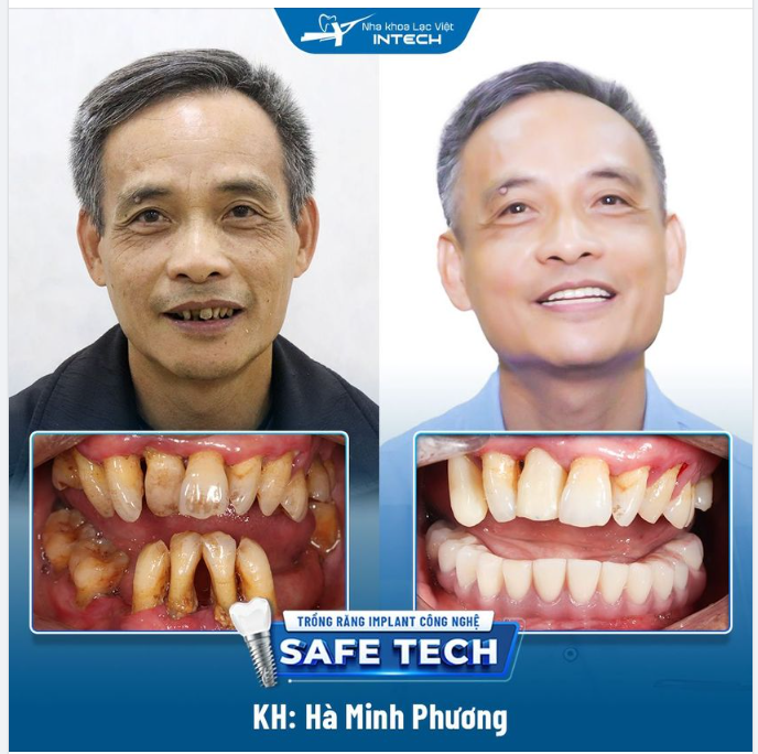 CẢI THIỆN ĂN NHAI, NÂNG CAO SỨC KHỎE NHỜ TRỒNG RĂNG IMPLANT