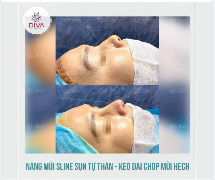 CẢI THIỆN MŨI NGẮN, HẾCH VỚI NÂNG MŨI SLINE SỤN TỰ THÂN