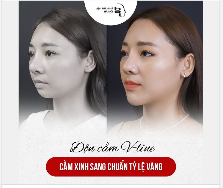 Cằm ngắn, lẹm khiến khuôn mặt mất cân đối