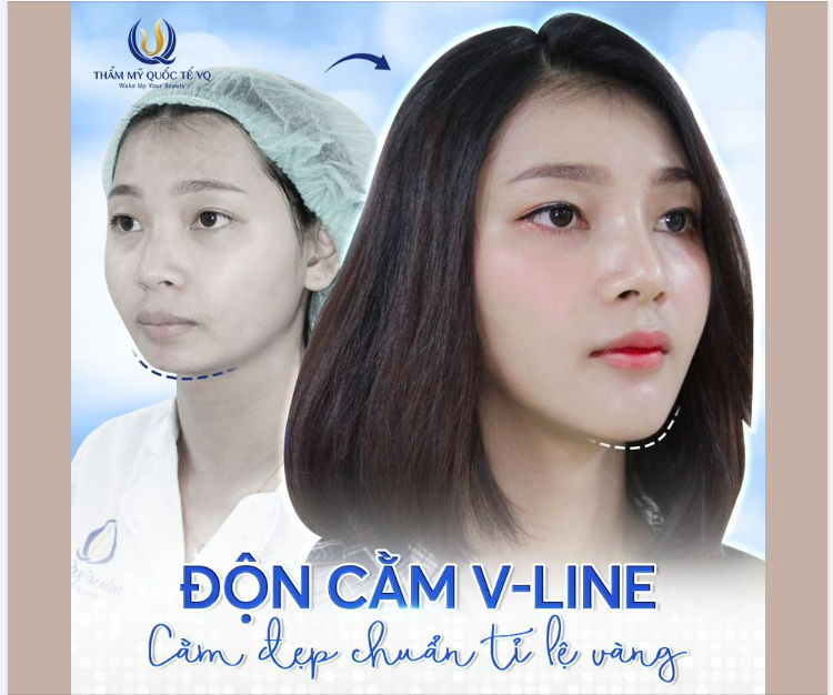 Cằm xinh sang - Chuẩn tỷ lệ vàng