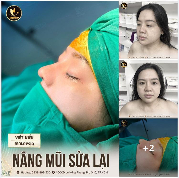 CẬN CẢNH CA NÂNG MŨI SỬA LẠI KHÁCH HÀNG VIỆT KIỀU MALAYSIA
