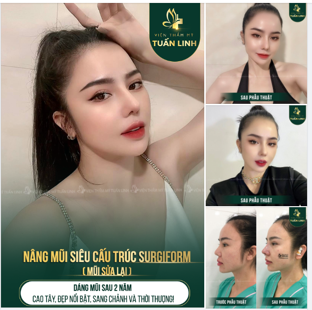 CẬN CẢNH DÁNG MŨI SAU 2 NĂM SỬA LẠI TẠI TUẤN LINH