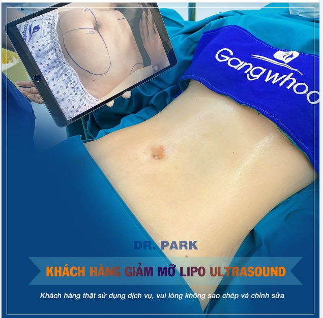 CẬN CẢNH KHÁCH HÀNG THỰC HIỆN XONG CA HÚT MỠ BỤNG BẰNG CÔNG NGHỆ LIPO ULTRASOUND