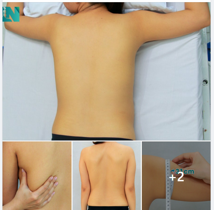 CÂN CHỈNH DÁNG VÓC CHO CHỊ KH 38 TUỔI ĐẾN TỪ ĐỒNG NAI.