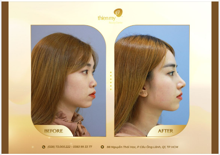 Cần chuẩn bị gì trước khi nâng mũi - Lời khuyên từ TMV Thiện Mỹ