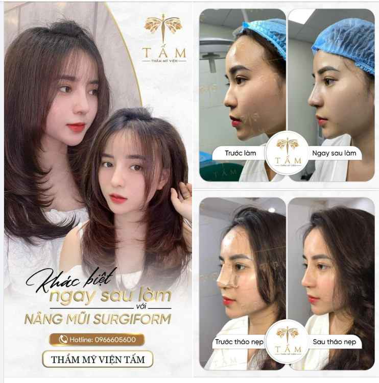 Can thiệp nhẹ nhàng và sự khác biệt ngay sau làm