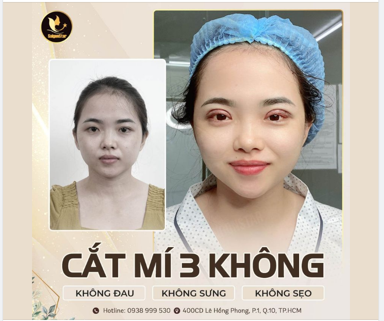 CẮT MÍ 3 “KHÔNG” CÙNG DR. HOẠT