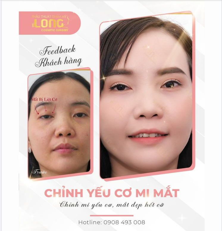 CẮT MÍ CHI PHÍ ƯU ĐÃI CÓ TẠI PTTM BÁC SĨ LONG