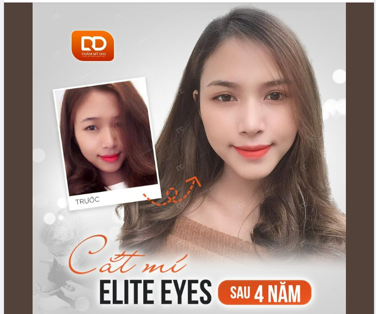 CẮT MÍ ELITE EYES ĐẸP ĐƯỢC BAO NHIÊU NĂM