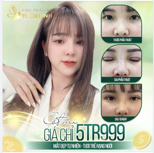 CẮT MÍ GIÁ CHỈ 5TR999 - MẮT HAI MÍ TO TRÒN - SẮC NÉT