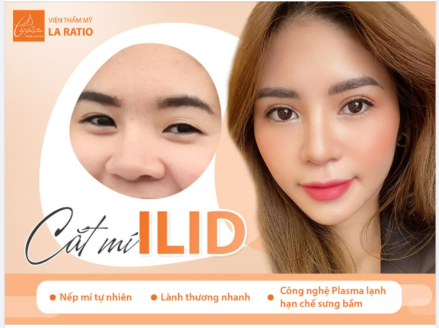 CẮT MÍ ILID – MẮT XINH THU HÚT MỌI ÁNH NHÌN