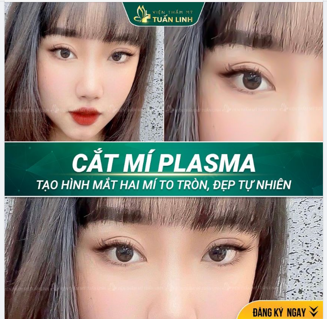 CẮT MÍ PLASMA - 7 NGÀY VÀO PHOM CHUẨN ĐẸP TỰ NHIÊN.