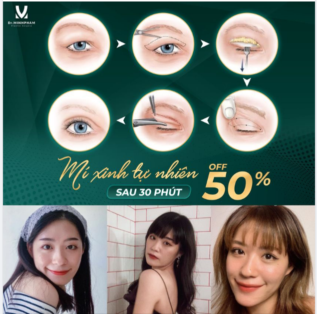 Cắt mí Silk Plus - Đẹp hơn cả mong đợi