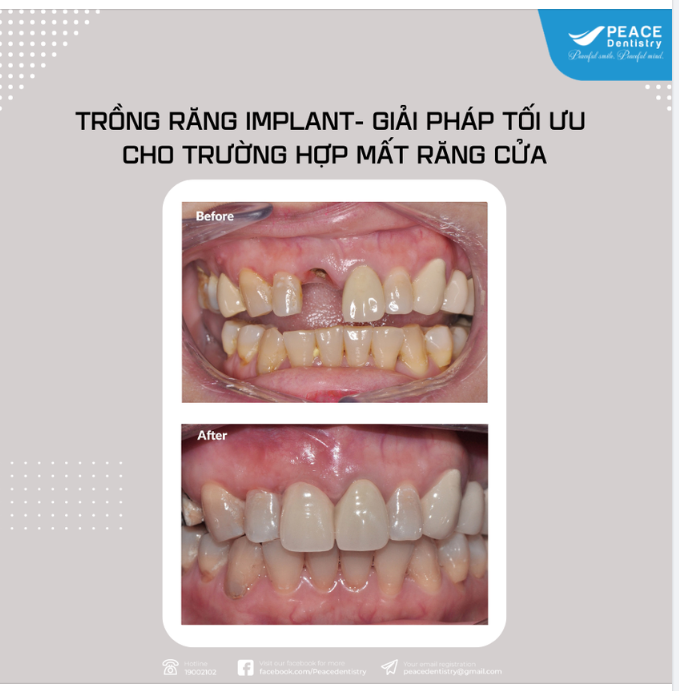 Cấy ghép Implant cho răng cửa và ghép nướu giúp đạt hiệu quả thẩm mỹ tối ưu