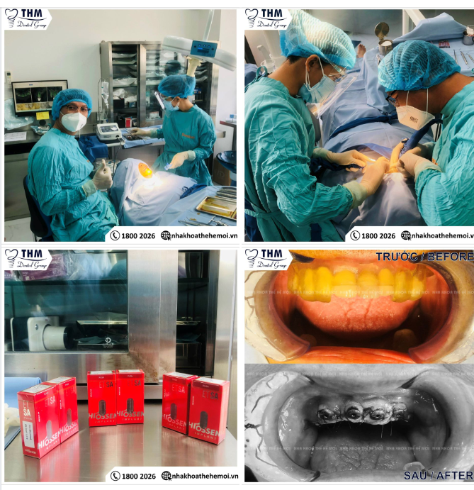 CẤY GHÉP IMPLANT HIOSSEN USA TẠI NHA KHOA THẾ HỆ MỚI