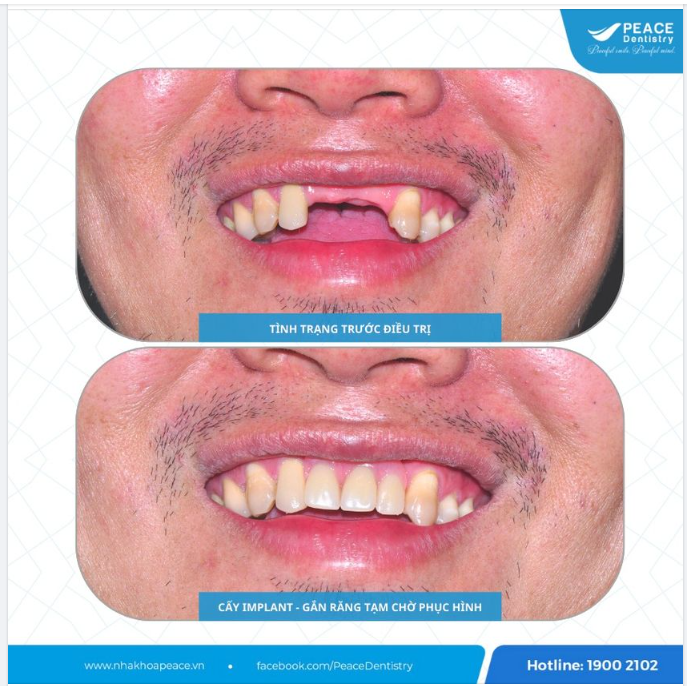 Cấy ghép Implant và phục hình răng sứ giúp khôi phục trọn vẹn chức năng ăn nhai và thẩm mỹ răng miệng.